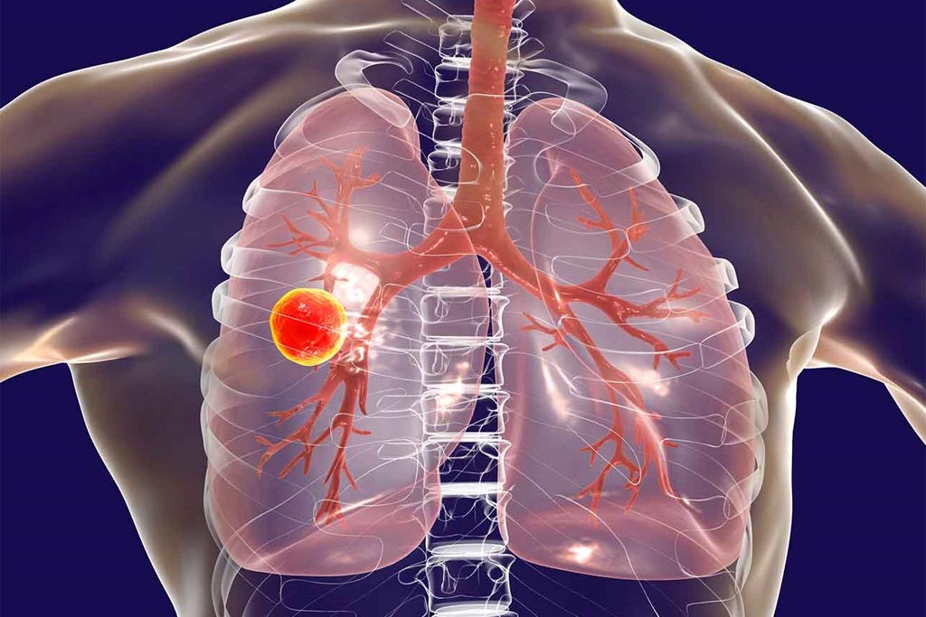 COPD Surgery